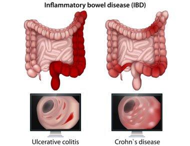 Beyaz arka planda inflamatuar bağırsak hastalığı tıbbi vektör illüstrasyon