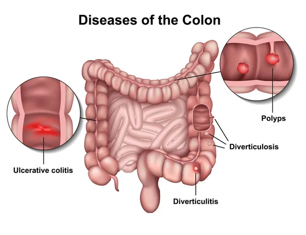 结肠疾病3D 医学媒介例证在白色背景 — 图库矢量图片