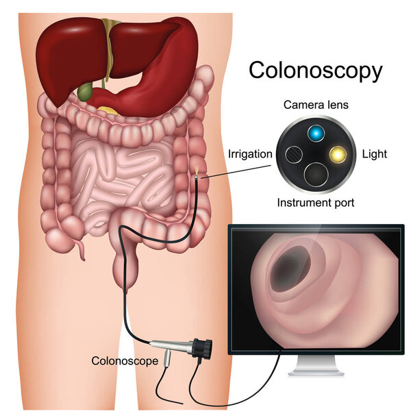 Colonoscopy procedure labeled 3d vector diagram on white background