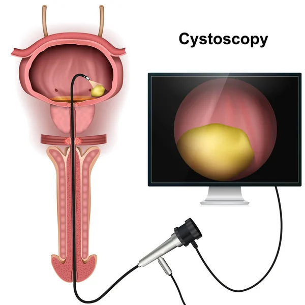 Cystoscopy Pęcherza Ilustracji Wektorowych Białym Tle — Wektor stockowy