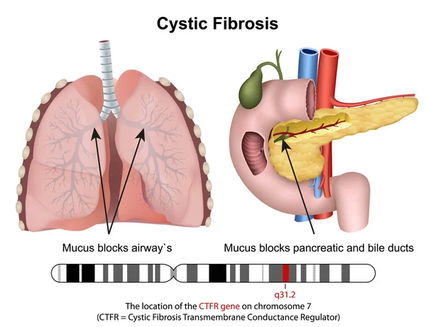 Fibrosis Cístriaca Vector Médico Ilustración Con Descripción — Vector de stock