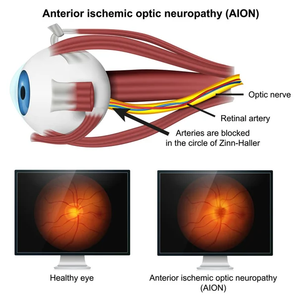 Ішемічна Оптична Нейропатія Медична Векторні Ілюстрації Білому Тлі — стоковий вектор