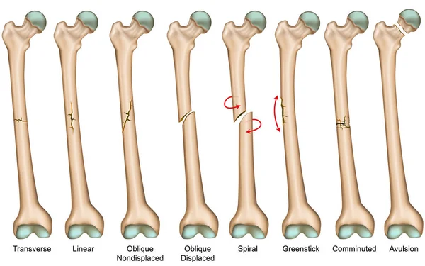 Csonttörés Típusú Orvosi Vektor Illusztráció — Stock Vector