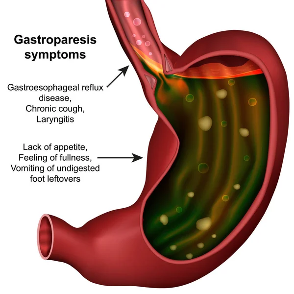 Gastroparesia Estômago Vetor Médico Ilustração Fundo Branco —  Vetores de Stock