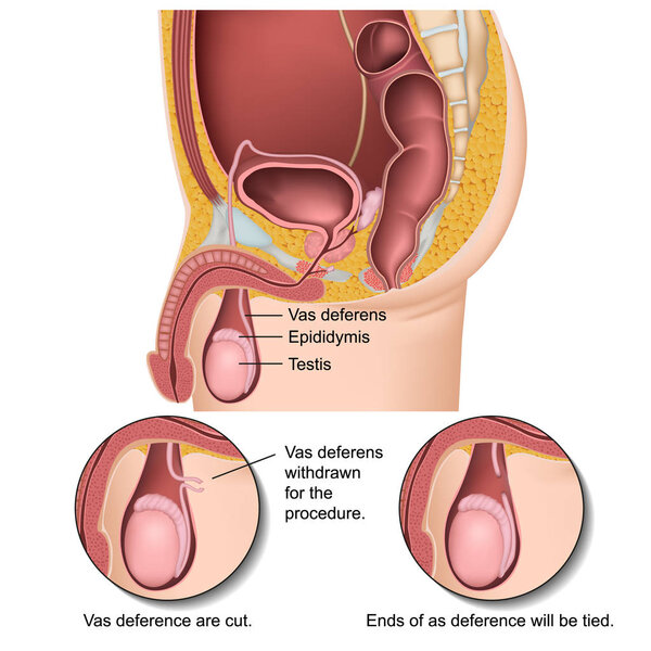 Male vasectomy procedure 3d medical vector illustration