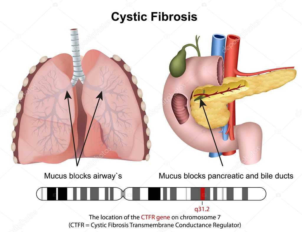 Cystric fibrosis 3d medical vector illustration with description