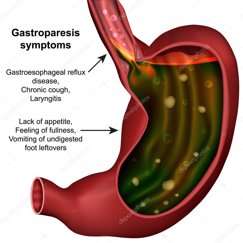 Gastroparesis stomach medical vector illustration on white background
