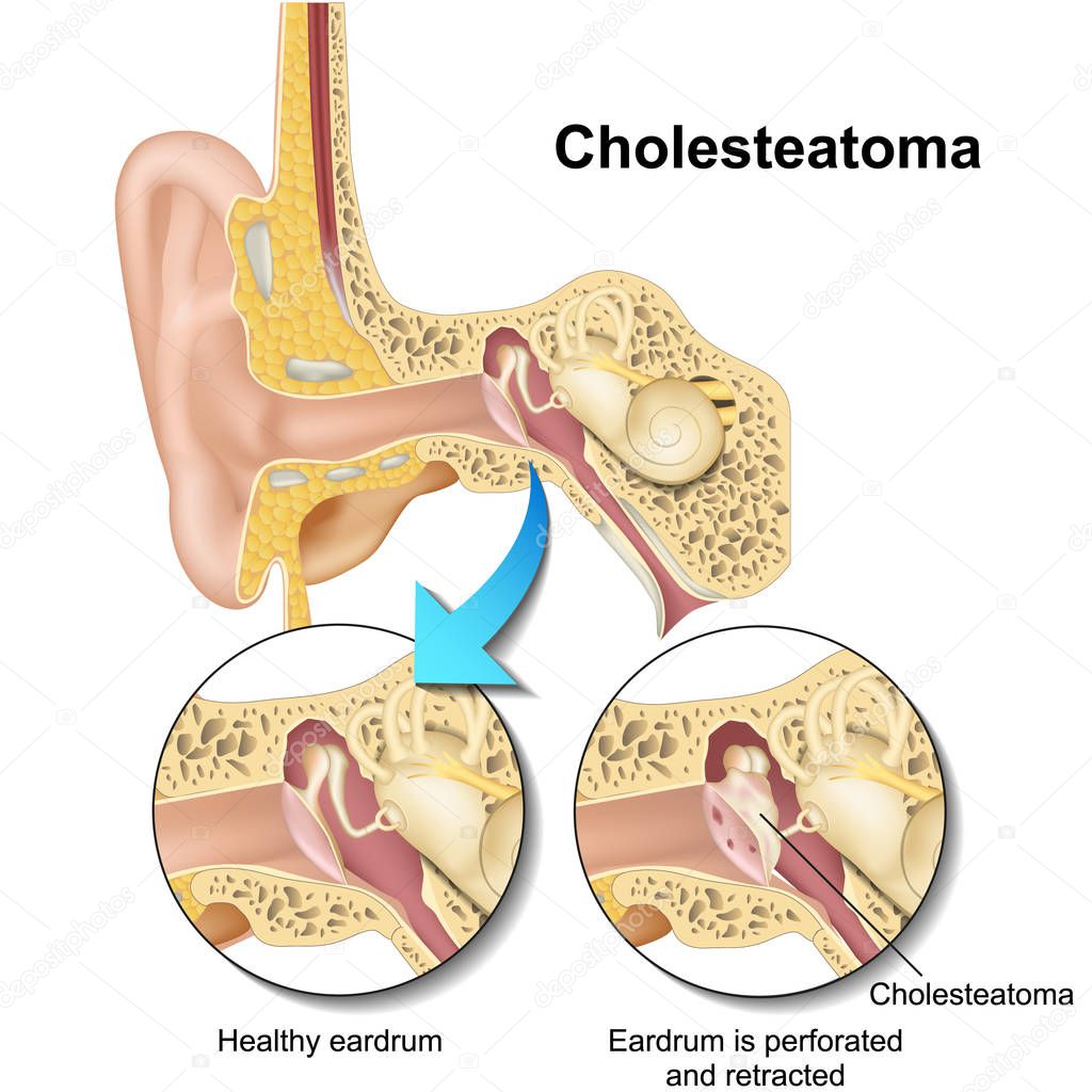 Cholesteatoma human ear anatomy vector illustraton on white background