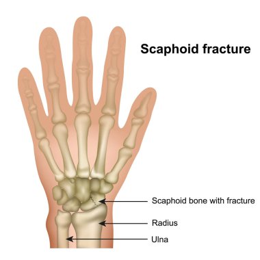 Beyaz arka planda Scaphoid kemik kırığı tıbbi vektör illüstrasyon