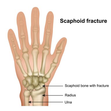 Scaphoid bone fracture medical vector illustration on white background clipart