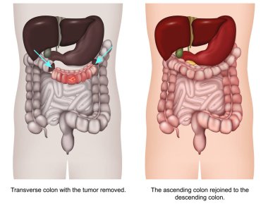 Transverse kolektomi 3d tıbbi vektör illüstrasyon