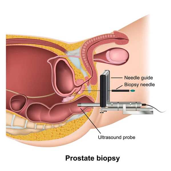 Biopsja Prostaty Medycyna Medyczny Ilustracja Wektor Białym Tle — Wektor stockowy