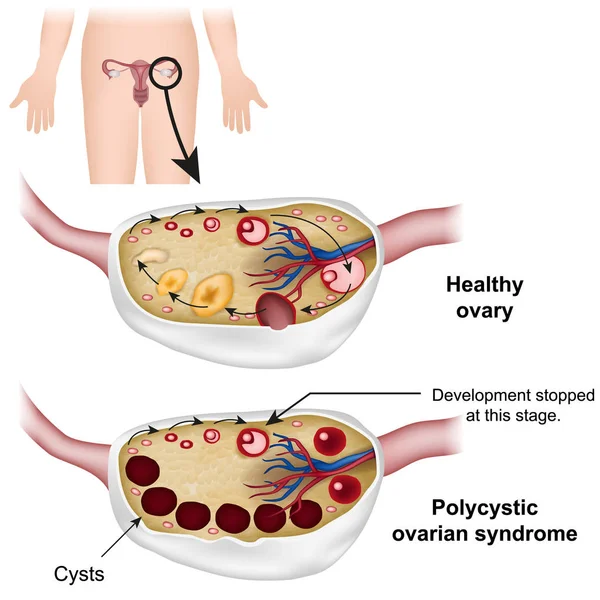 Illustration Vectorielle Médicale Syndrome Ovarien Polykystique — Image vectorielle