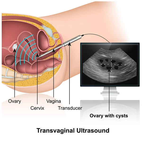Transvaginalt Ultraljud Checkup Medicinsk Vektor Illustration — Stock vektor