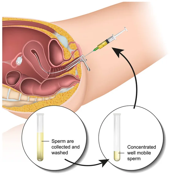 Intrauterin Insemination Graviditet Medicinsk Vektor Illustration — Stock vektor