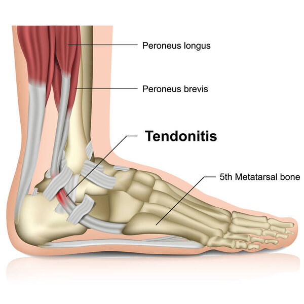 peroneal tendonitis, ankle joint 3d medical vector illustration
