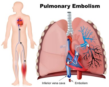 Beyaz arka planda açıklama ile pulmoner embolizm tıbbi vektör illüstrasyon