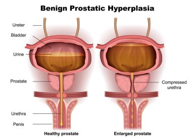 Benign prostat hiperplazisi 3d tıbbi vektör illüstrasyon