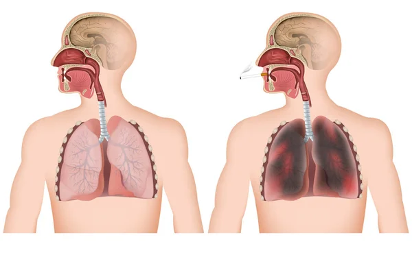 Fumar Ilustración Vector Médico Pulmonar Sobre Fondo Blanco Hombre Con — Vector de stock