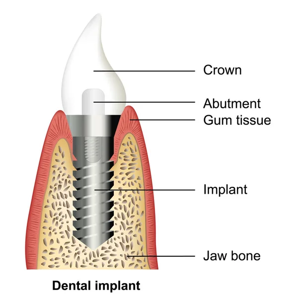 Ilustración Del Vector Médico Del Implante Dental Sobre Fondo Blanco — Vector de stock