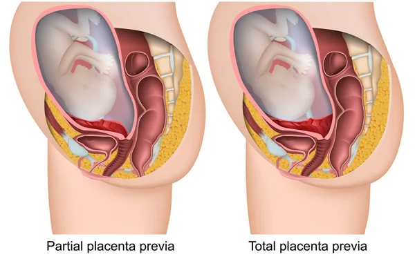 Placenta Brevia Embarazo Vector Ilustración Sobre Fondo Blanco — Vector de stock