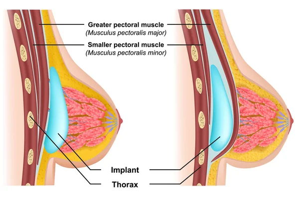 乳房植入物插入医学载体例证 — 图库矢量图片