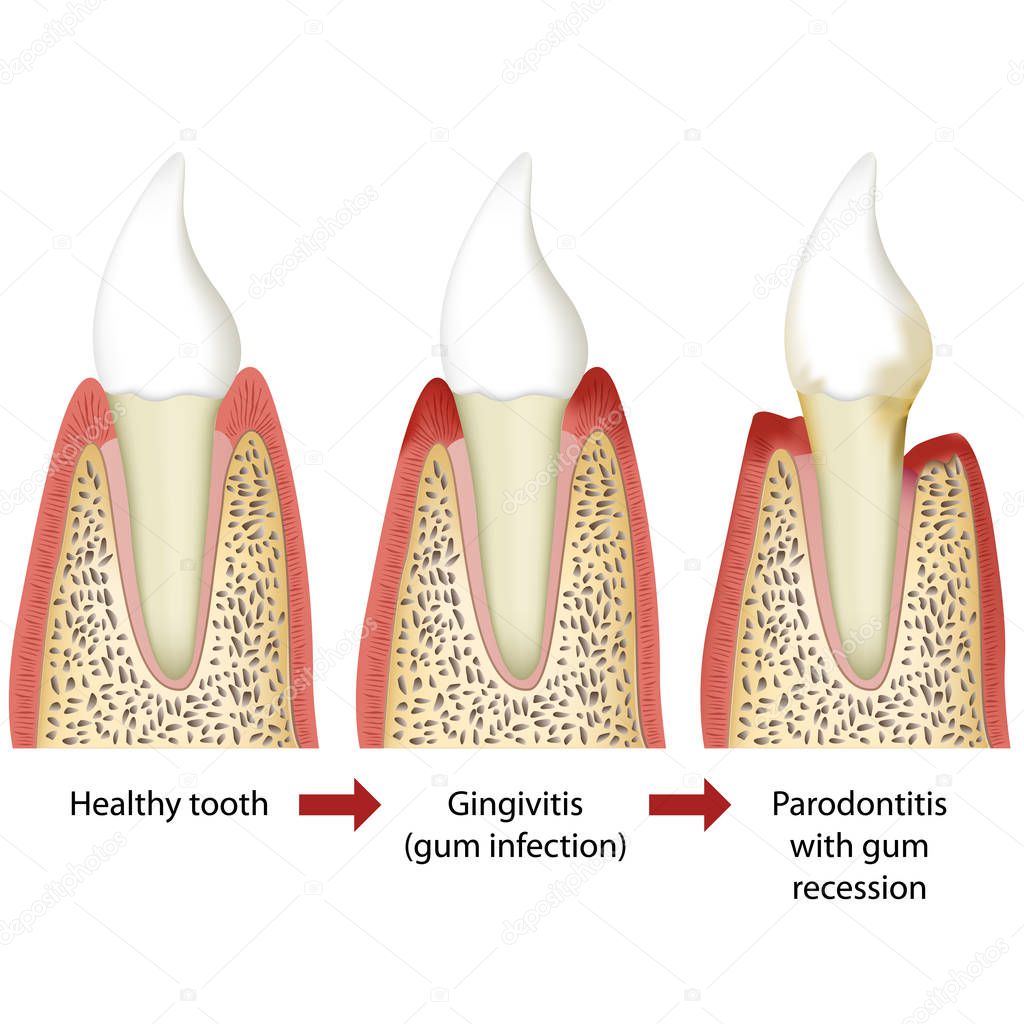Stages of periodontitis medical vector illustration white background