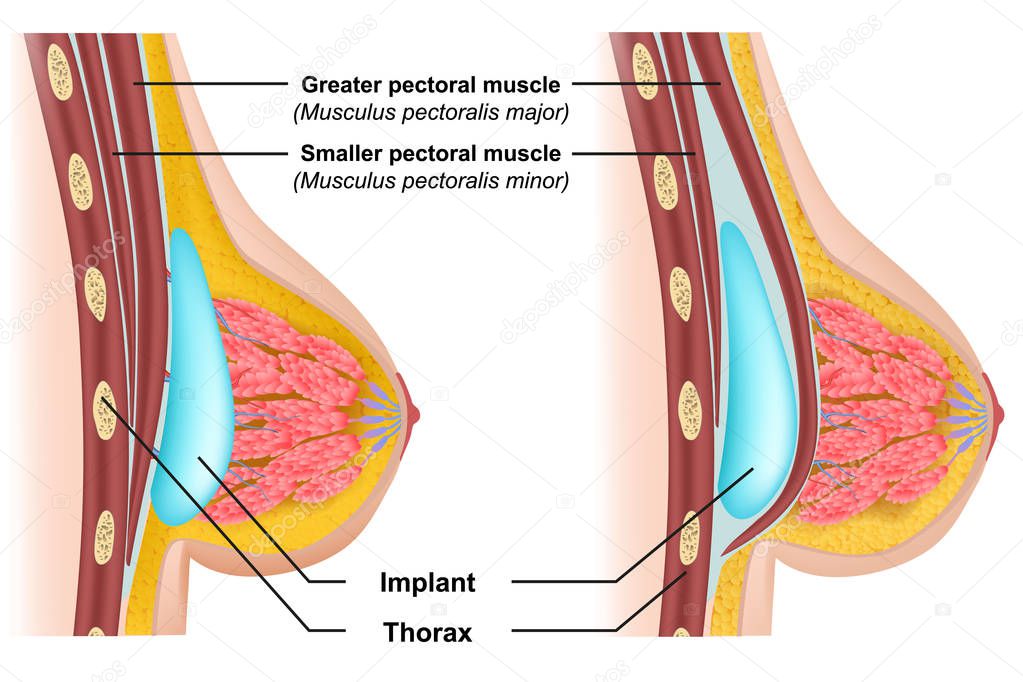 Breast implant insertion medical vector illustration