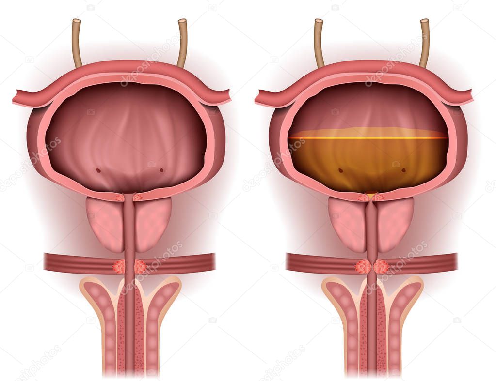Bladder empty and filled with urine 3d medical vector illustration