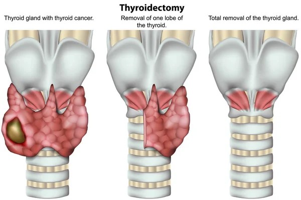 Tiroidectomia Glândula Tireóide Ilustração Vetor Médico Fundo Branco —  Vetores de Stock