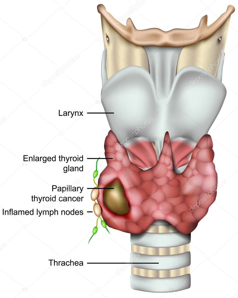 Thyroid cancer 3d medical vector illustration on white backround