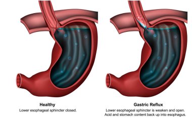 Gastric reflux 3d medical vector illustration with english description clipart