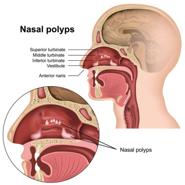 Nazal polip tıp vektör çizim beyaz arka plan üzerinde