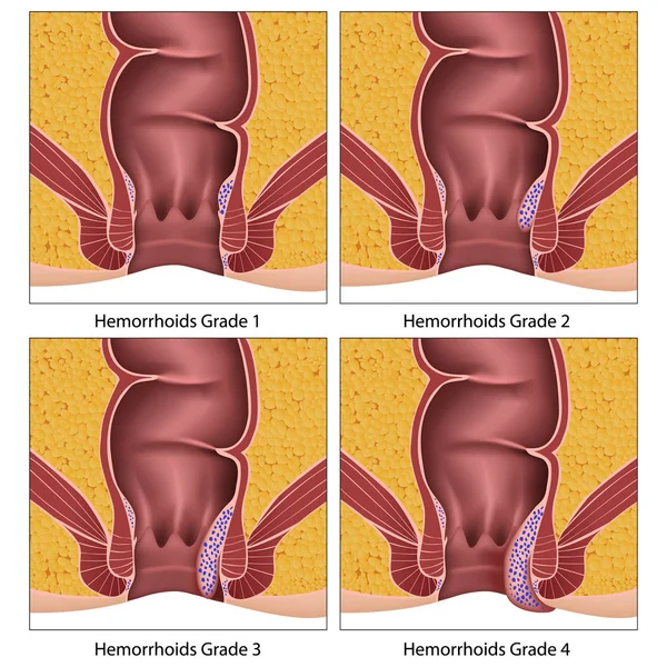 Hemorrhoids Grade Anatomy Education Info Graphic White Background — Stock Vector