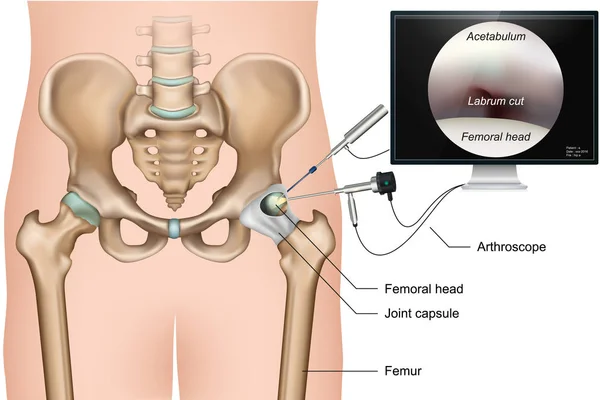 Artroscopia Cadera Vector Médico Ilustración Sobre Fondo Blanco — Archivo Imágenes Vectoriales