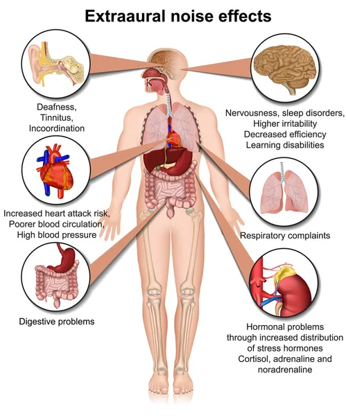 Efectos Sobre Salud Extraaurales Exposición Crónica Ruido Ilustración Vectorial Médica — Archivo Imágenes Vectoriales