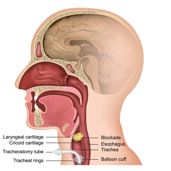 Tracheotomy Medical Vector Illustration White Background — Stock Vector