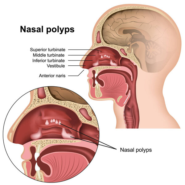 Nasal polyps medical vector illustration on white background