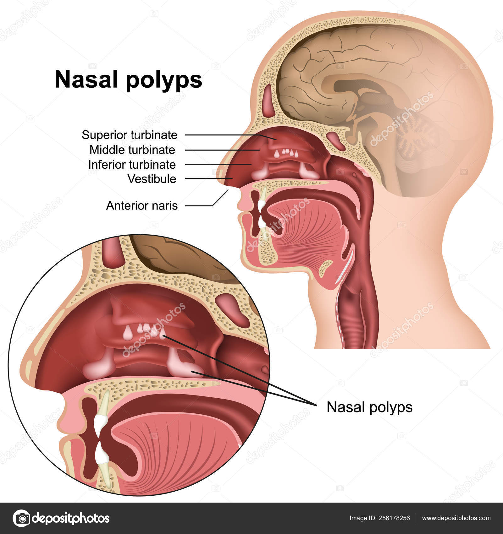 白色背景Eps 上的鼻息肉医学矢量插图图库矢量图©medicalstocks 256178256
