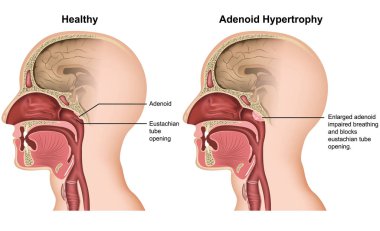 Adenoid hipertrofisi tıp vektör çizim beyaz arka plan üzerinde