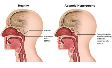 Adenoid hypertrophy medical vector illustration on white background clipart
