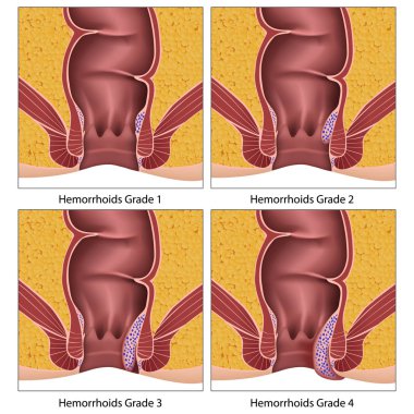 Hemorrhoids grade anatomy education info graphic on white background clipart