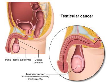 Testicular cancer medical vector illustration clipart