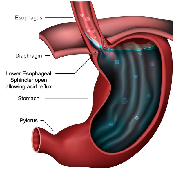 Esophagealsphincter Anatomía Reflujo Vector Médico Ilustración — Vector de stock