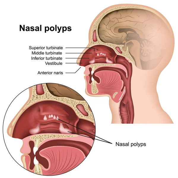 Pólipos Nasales Vector Médico Ilustración Sobre Fondo Blanco Eps — Archivo Imágenes Vectoriales