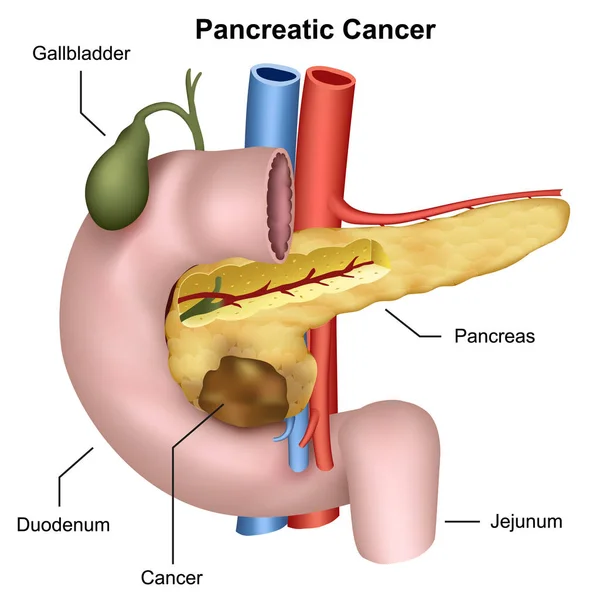 Cáncer Páncreas Ilustración Vector Médico Anatomía Del Páncreas — Vector de stock