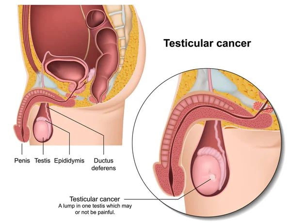Illustrazione Vettoriale Medica Del Cancro Testicoli — Vettoriale Stock
