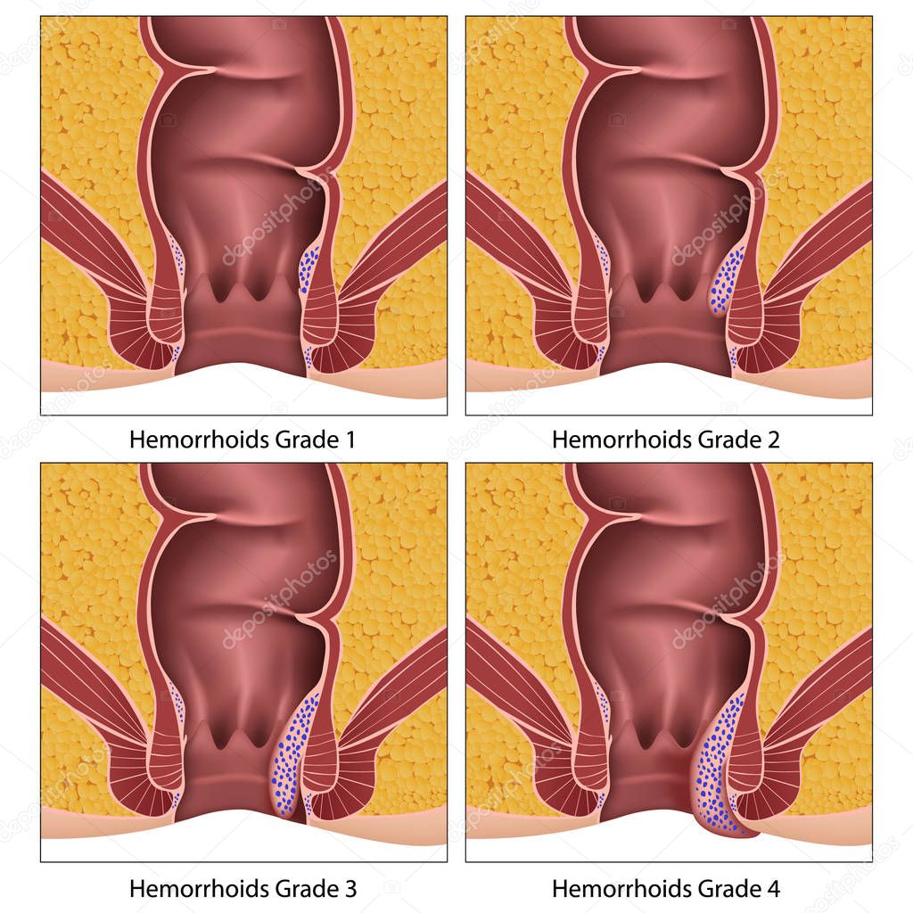 Hemorrhoids grade anatomy education info graphic on white background
