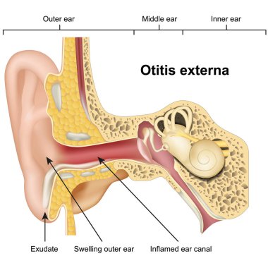 Beyaz arka planda Otitis externa kulak hastalığı 3d tıbbi vektör illüstrasyon