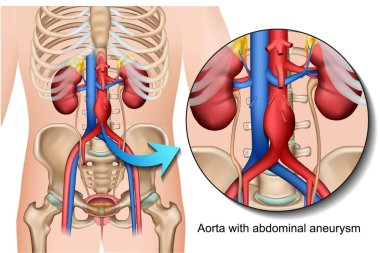 Aort abdominal anevrizma 3d tıbbi vektör illüstrasyon beyaz arka plan üzerinde izole